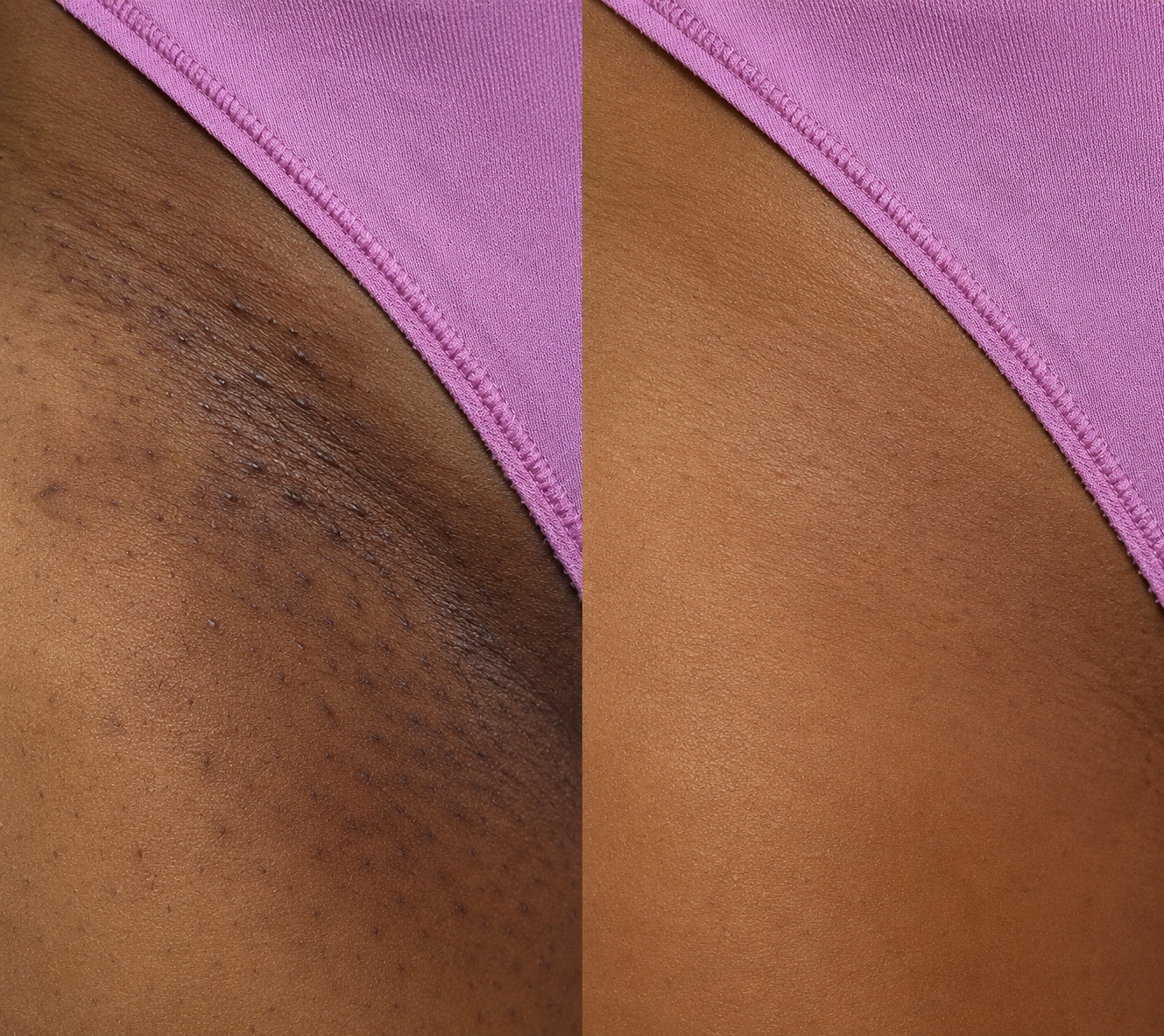 Bikini line before and after