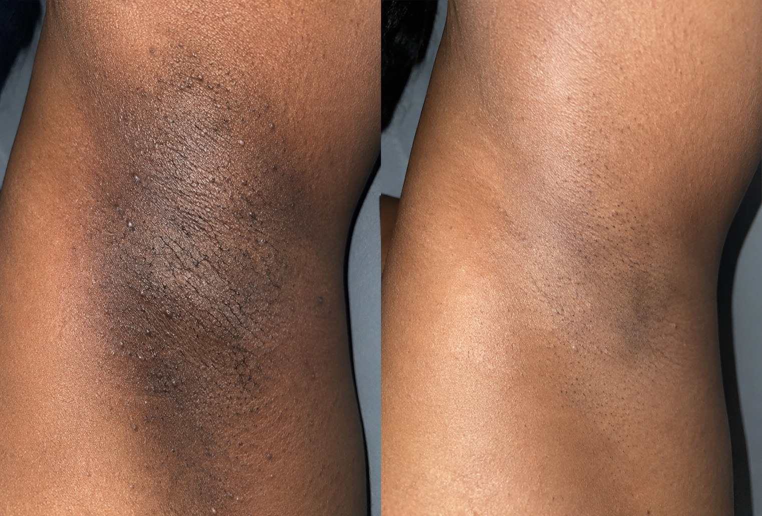 Underarm before and after